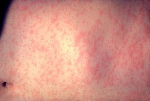 Vaccinia virus, Adenoviruses, Maraba virus, Reovirus, Measles, Herpes simplex, Murine norovirus, Enterovirus, Zika virus, HIV virus, virus, Health, medical uses, science